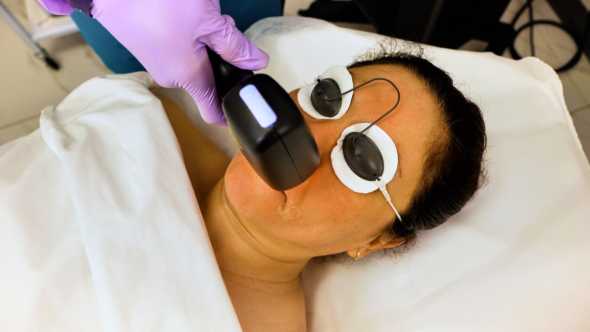 The Best Laser Hair Removal North Vancouver Skin Blossom Pro