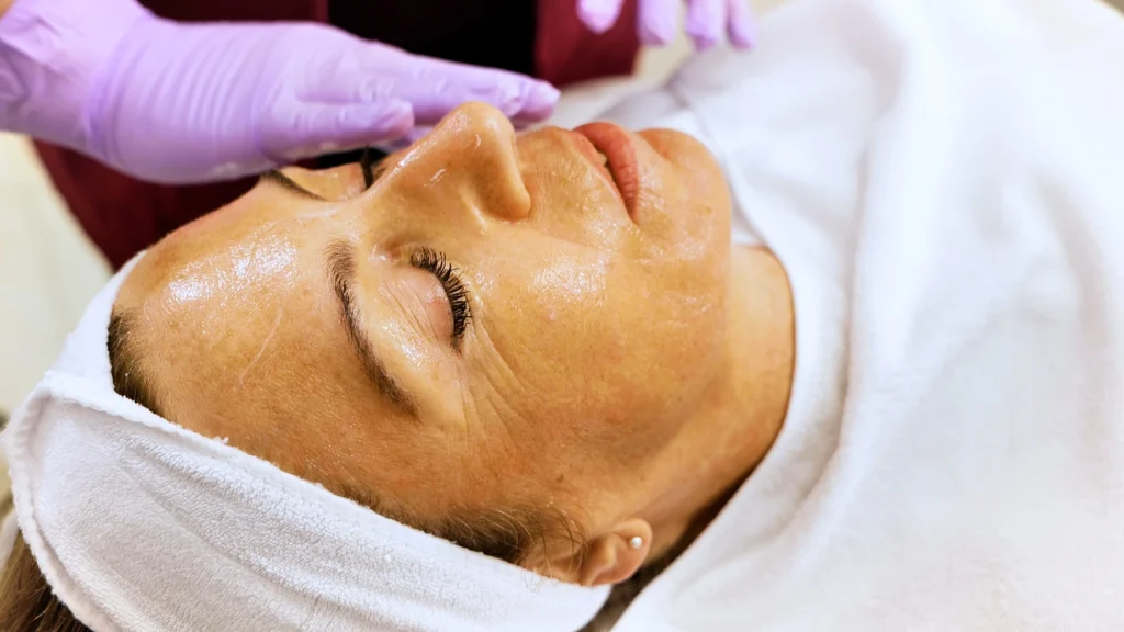 Chemical Peel North Vancouver