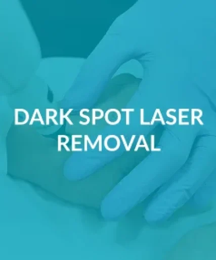 Dark Spot Laser Removal