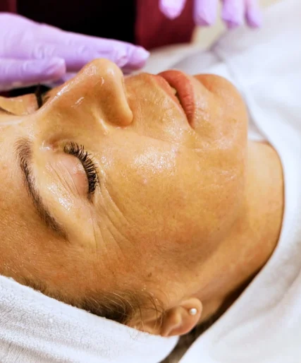 Chemical Peel North Vancouver